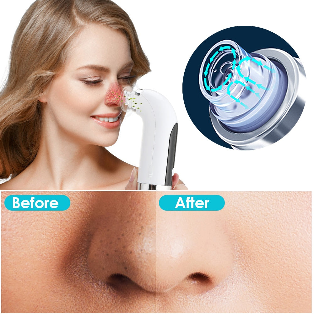 Blackhead Remover Pore Cleaner Vacuum Suction Acne Remover Pimple Black Dot Removal Facial Cleaning Beauty Tools Face Skin Care